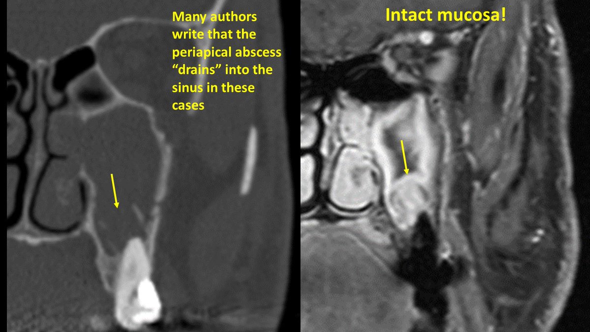 JohnCraigNose's tweet photo. Working on one of these #OtoClinics #OCNA chapters for our #ODS issue coming later this year. Looking for the perfect figures to spice things up, and came across this gem from years ago (but probably won't be in the book). Just so good at teaching that continuity between a periapical lesion on CT and what you think is the maxillary sinus lumen, is NOT usually a direct communication through the sinus mucosa. Bacteria can still spread of course. This book is going to be pretty cool 😎🧐👃🦷 @henryfordent @ent_ams