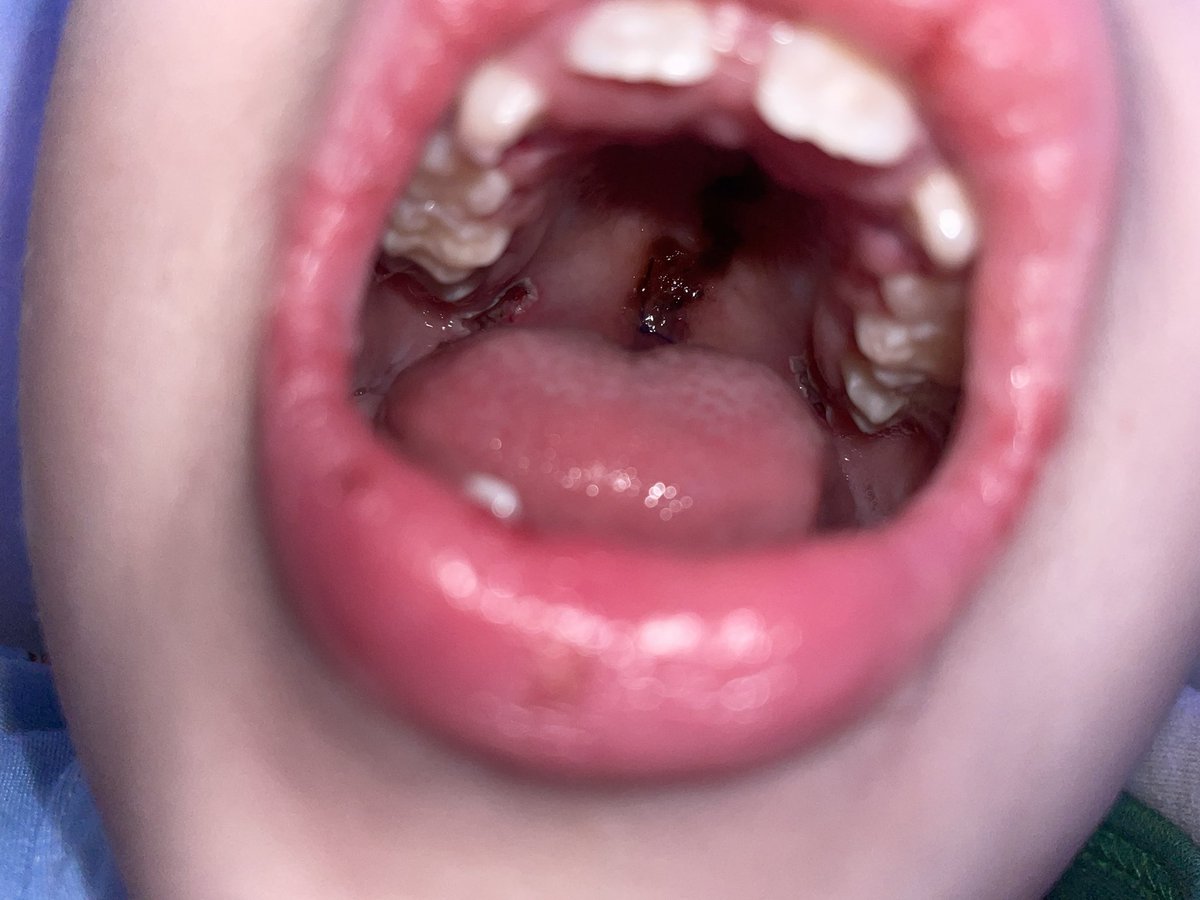 TheArtieMoore's tweet photo. Been a long week in the hospital for the warrior. Added to his list of battle scars include a reconstructed cleft palate & pharyngeal flap insert (with 3 sets of mouth stitches) along with a g-tube. Hard times come and hard times go. Don’t sweat the small stuff. #ItsAHelluvaLife https://t.co/Zrk6cxjfvU