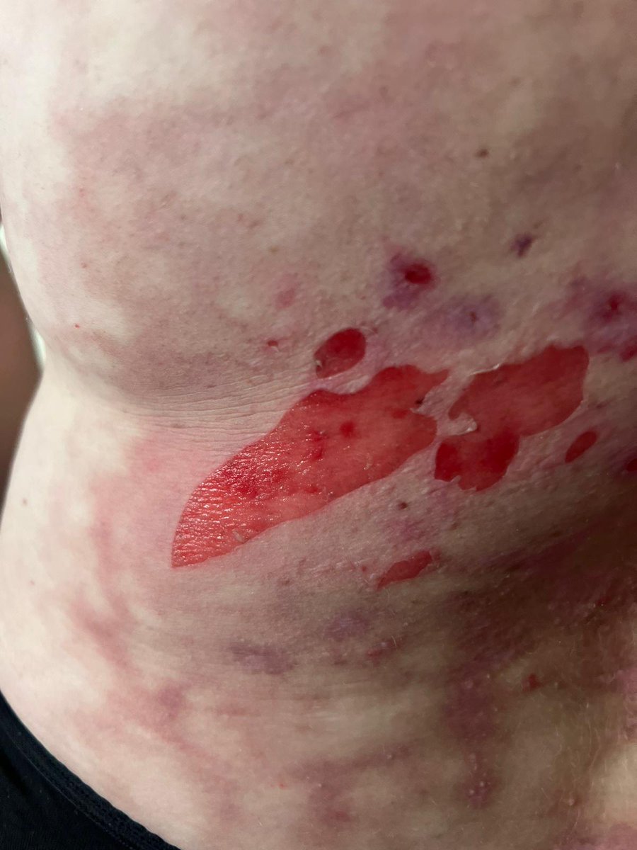 IsobelKnight2's tweet photo. #Healthjournalists #DWP #selfharm #MentalHealthSupport #Scope #Thei #TheGuardian #TheTimes #SkyNews #BBC #BBCHealth I have a story. I'm happy to speak about the attached image. Why it happened. #Tories https://t.co/3CvtnLnIFr