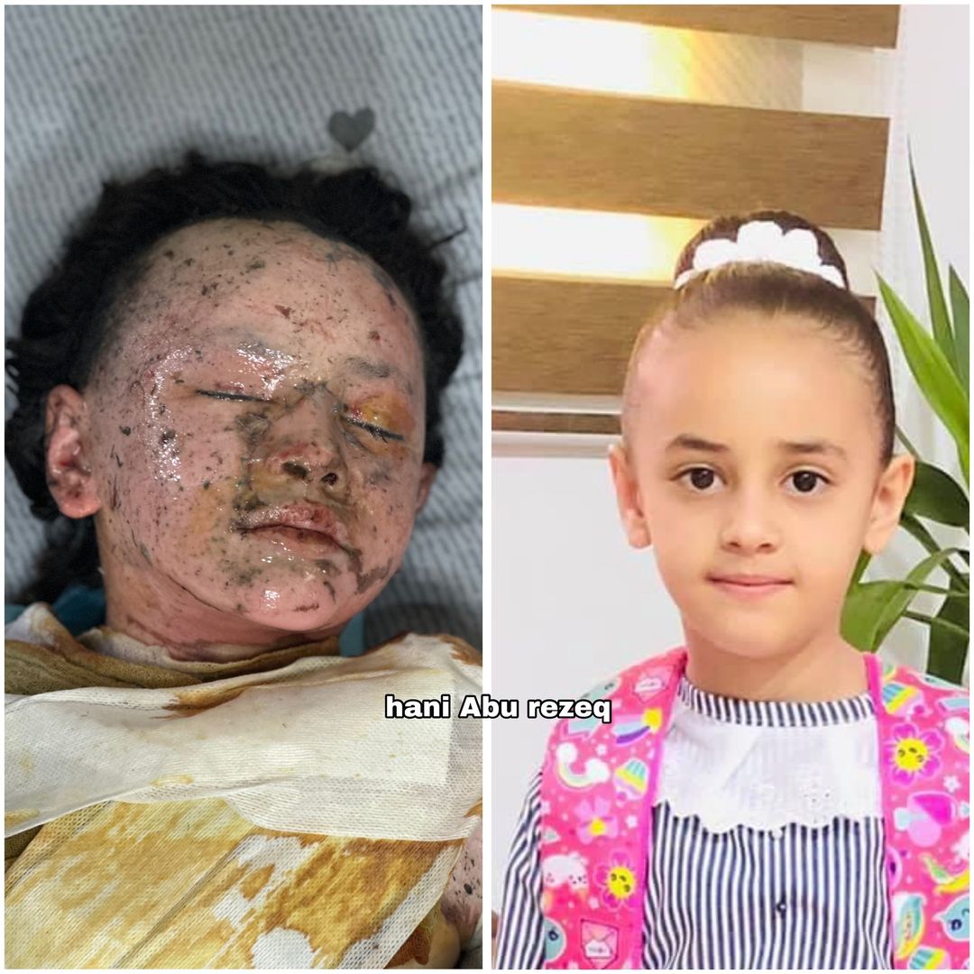 Bu çocuğun adı Hanan Akel 10 yaşında Gazzeli bir çocuk.. Hanan tatlı almaya giderken terörist İsrail tarafından vuruldu yüzü ve vücudu tamamen yandı.

Çocuk Hanan'ın yurtdışında tedavi edilmesi gerekiyor.. Lütfen Hanan'ın sesi olun