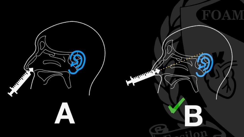 Don't have them sniff. The act of sniffing generates negative pressure generated by inspiration. You want the medication to stay in the nose and not go down the throat. In addition, you want to aim at the helix (top) of the ear.
