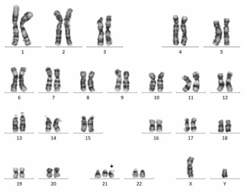 SCIENCEVIVID2's tweet photo. Down syndrome is a genetic disorder that occurs when there is an extra copy of chromosome 21. 
https://t.co/TU7gs3C1EC
#sciencevivid #downsyndrome https://t.co/mPgXLpXOn0