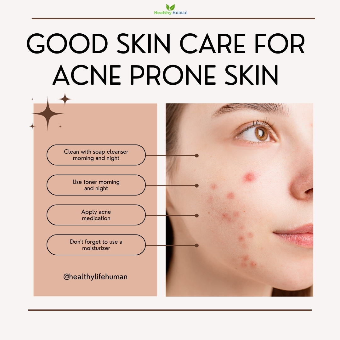 HealthyLifeHum's tweet photo. 📢 PROTECTION OF ACNE-PRONE SKIN:

🌐 Visit us:https://t.co/xVK6pXS9Pe
Follow for more @healthy_life_human

#acneskincare #skincare #acnetreatment #acne #skincareroutine #acneproblems  #acneproneskin #skincareproducts #skincaretips https://t.co/JP1UYohBDW