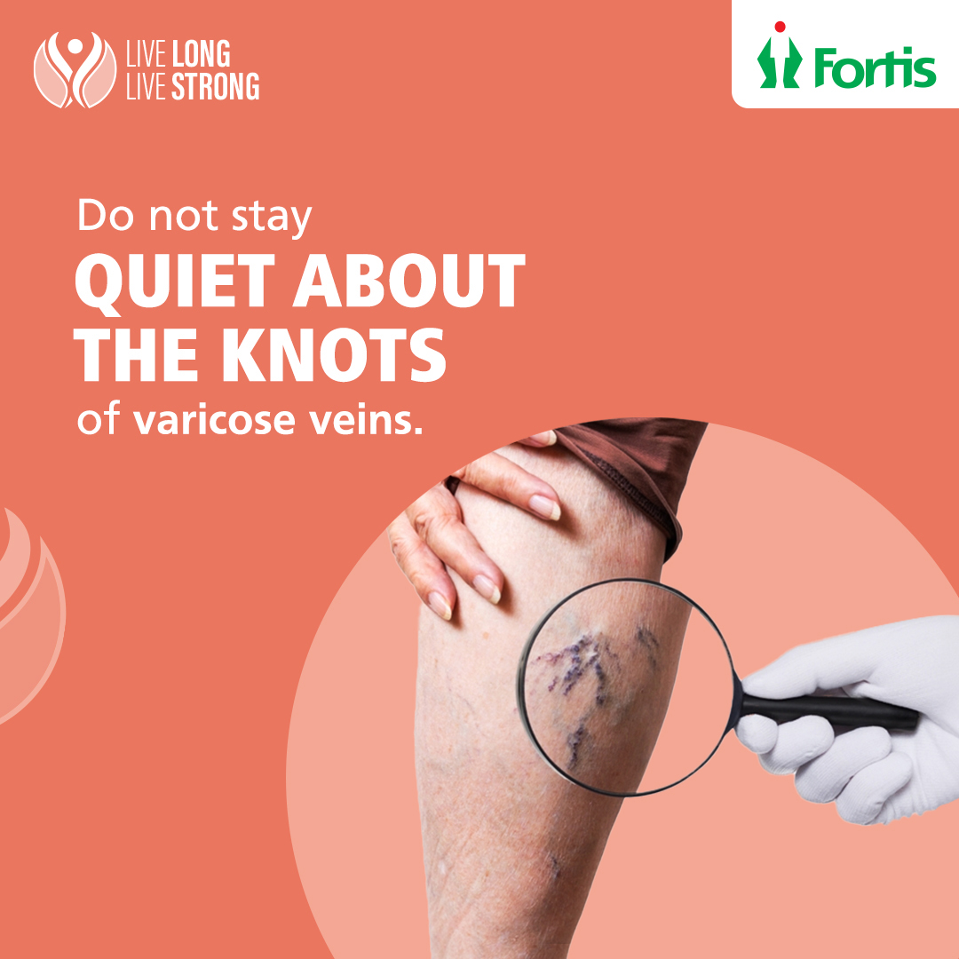 fortis_hospital's tweet photo. Varicose veins usually develop on the legs and thighs.
They are generally harmless but can become painful and tender when swollen.
If you face any of these symptoms, reach out to us.
#LiveLongLivestrong #AtFortisWeCare #FortisHealthcare #VaricoseVeins #Knots https://t.co/6bXdFMj7qN