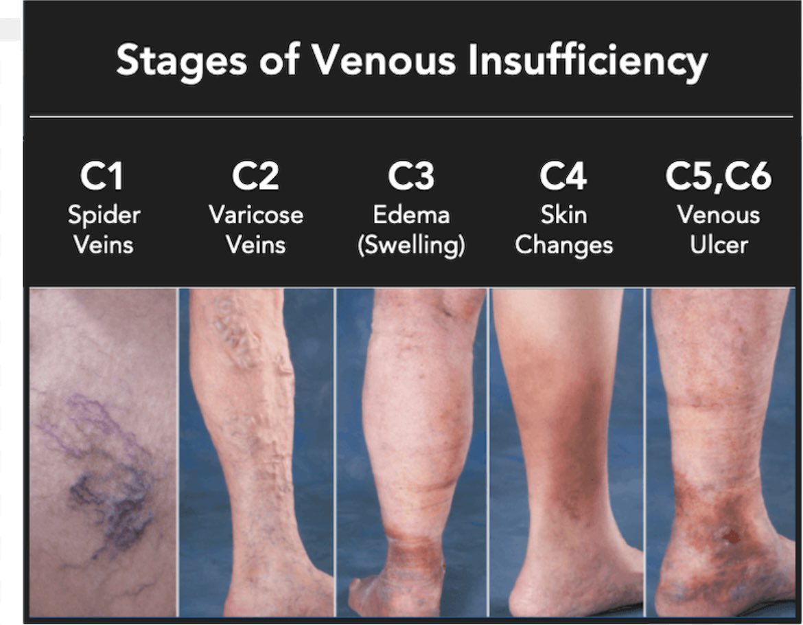 LEGS MATTER WEEK

Come and join us up on level 7 in derriford today to talk about how to keep your legs healthy!

Venous disease affects so many people worldwide, prevention over cure!

#legsmatter <a href="/UHP_NHS/">University Hospitals Plymouth NHS Trust</a> <a href="/TVteamDerriford/">Tissue Viability UHPT</a> <a href="/DerrifordNurses/">UHP Nursing 💙</a> <a href="/mediUKLtd/">medi UK Ltd</a> <a href="/UrgoMedicalUKI/">Urgo Medical UK & Ireland</a>