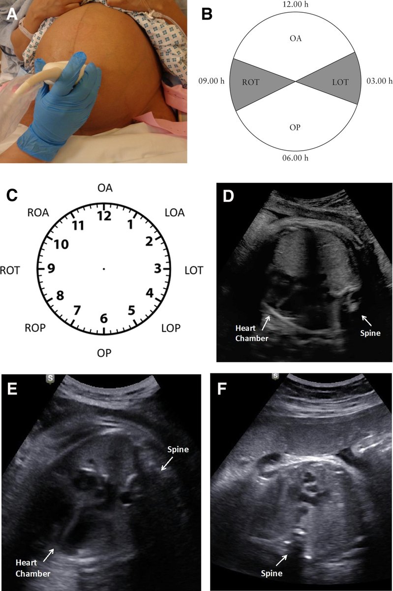 AJOG_thegray's tweet photo. AJOG Expert Review in Labor:  The sonopartogram: Transabdominal ultrasound scan for the fetal spine position https://t.co/WSzo7YoBTJ https://t.co/ygB0tupwwo