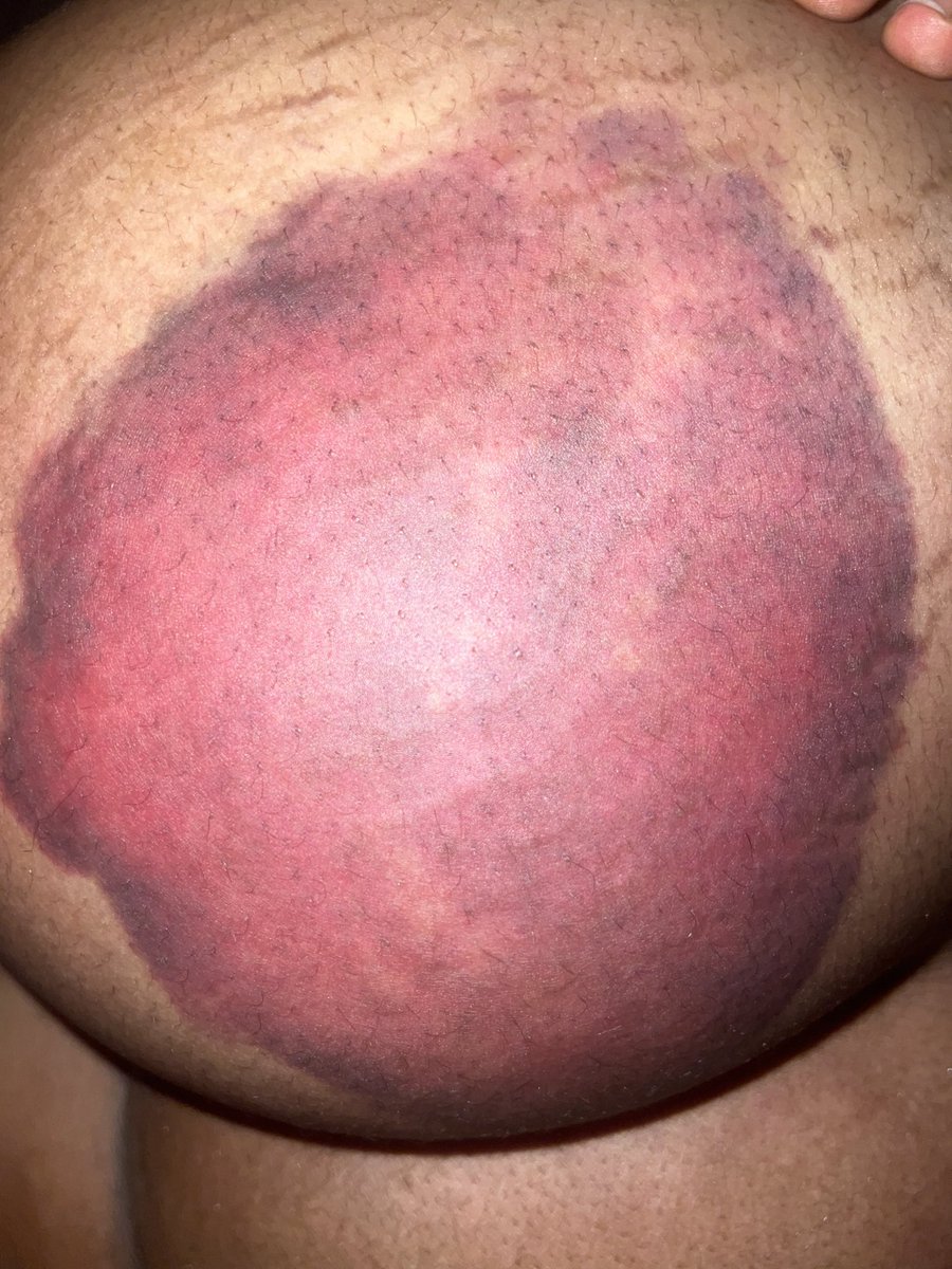 A lady approached me at the #StopEfccBrutality protest today. She sent me these pictures of her injuries. This is what the rogue <a href="/officialEFCC/">EFCC Nigeria</a> officials who came to raid in Akure last Saturday did to her.