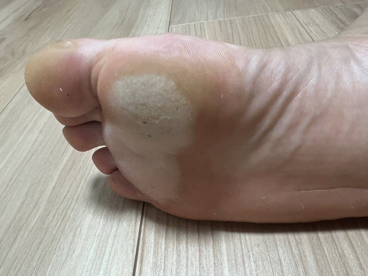 ヤバい、一日中スニーカー履いてたら蒸れてふやけちゃった。
なんか臭いと思ったらこれだった🥲