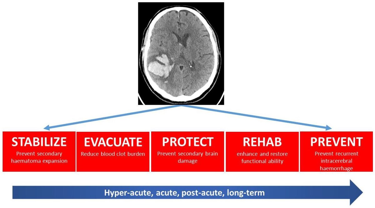 IntJStroke's tweet photo. 🧠🩸Don't miss this month's leading opinion, reviewing the latest research advances in intracerebral hemorrhage.

https://t.co/gH45CYLxuk @CamStroke https://t.co/IGv2ISudZ5