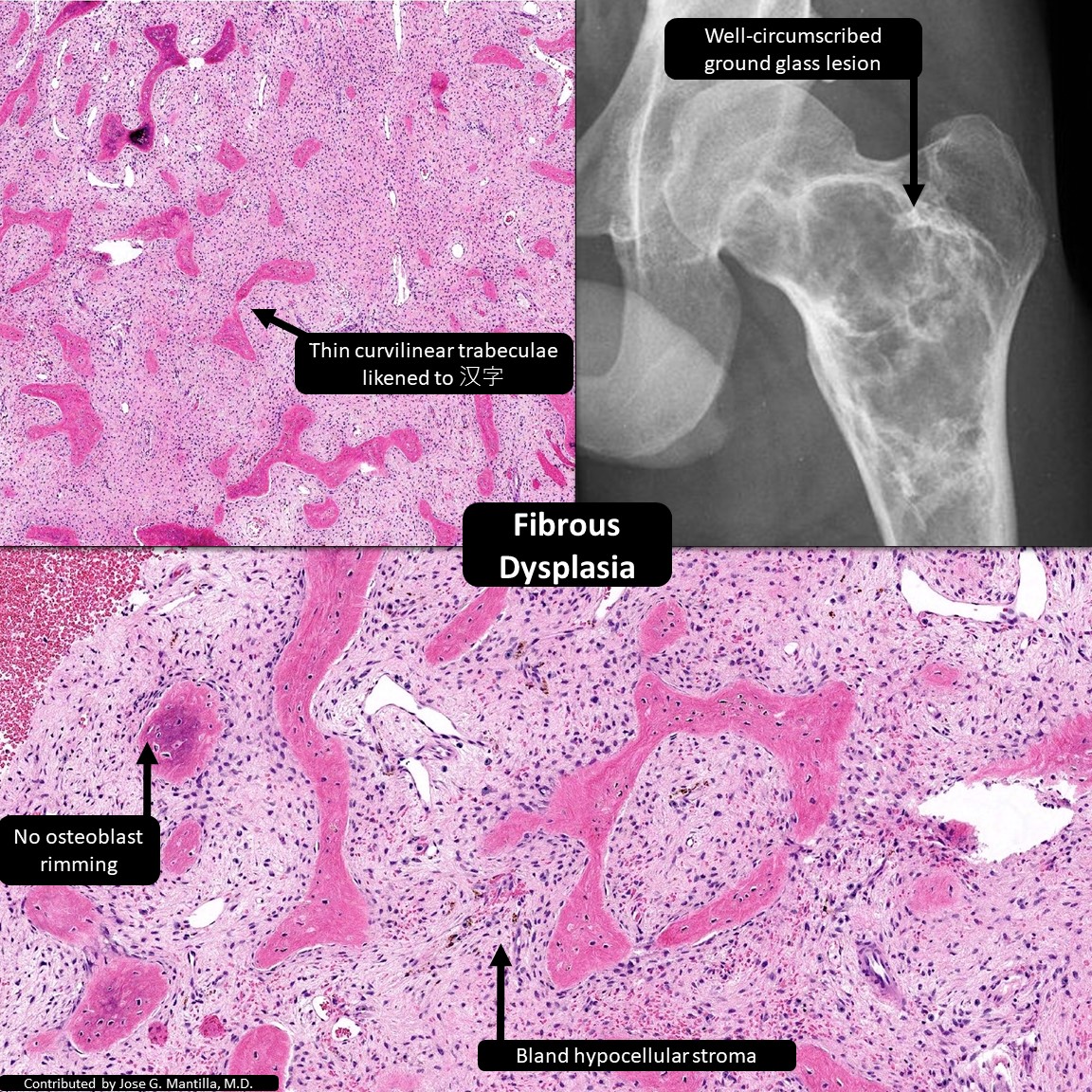 DrCycloPath's tweet photo. ❌GCT of bone: adults, oval mononuclear cells (not spindled like NOF), giant cell nuclei ~ mononuclear cell nuclei that are (+) H3.3 G34W
❌ Fibrous dysplasia: well-demarcated ground glass lesion;  irregular trabeculae in background of bland spindle cells
✅Non-ossifying fibroma: kids, metadiaphyseal lobulated lesion with sclerotic rim; bland storiforming fibroblasts, interspersed osteoclast-like multinucleated giant cells
#PediPath #BSTPath #PathTwitter #Pathology