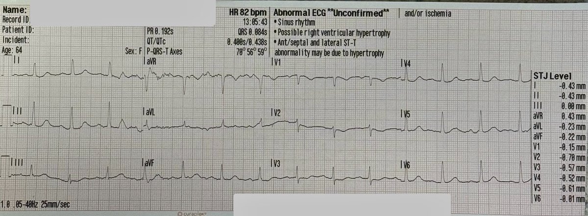 DitchDocEM's tweet photo. 64 F presents to EMS w/epigastric pain which progressively worsened over the past 3 hours.  No Hx except for mild HTN over the past 2 weeks, managed w/beta blockers by her PCM.  Pt did not want #EMS, but a co-worker insisted and called 911.  Dx?  #ECG #EKG #Paramedic #FOAMed. https://t.co/wEnB5e0Oy2