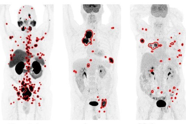 AuntMinnie's tweet image. An AI PET/CT tool accurately segments tumors for multiple cancers, according to research presented at #SNMMI24.
buff.ly/4aQDWPO

#RadiologyAI #ImagingAI #NuclearMedicine #radiology @SNM_MI