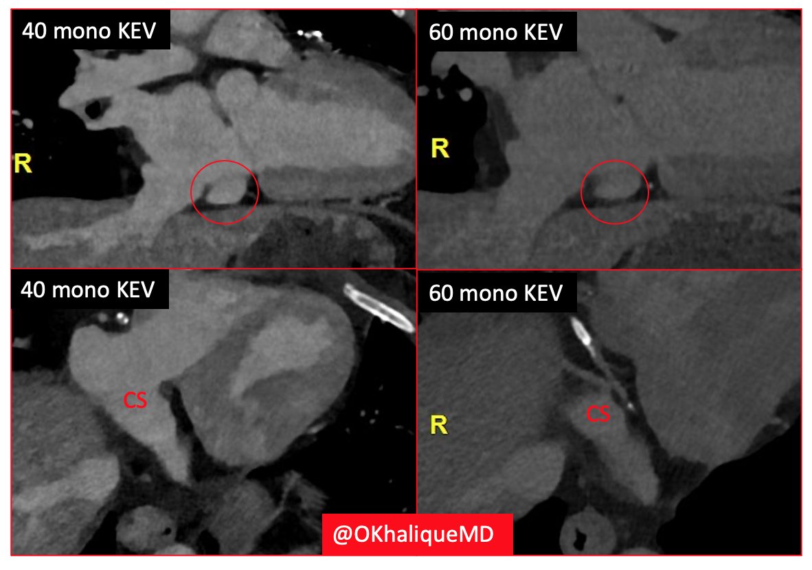 OKhaliqueMD's tweet photo. The power of  #PCDCT in daily practice. Delay phase scan for coronary sinus measurements - original 60 mono KEV recon too dim. 40 KEV excellent. @Heart_SCCT @purviparwani @onco_cardiology @rooshaparikh @DrRyanPDaly @djc795 @ziadalinyc https://t.co/LhQVMjqlm7