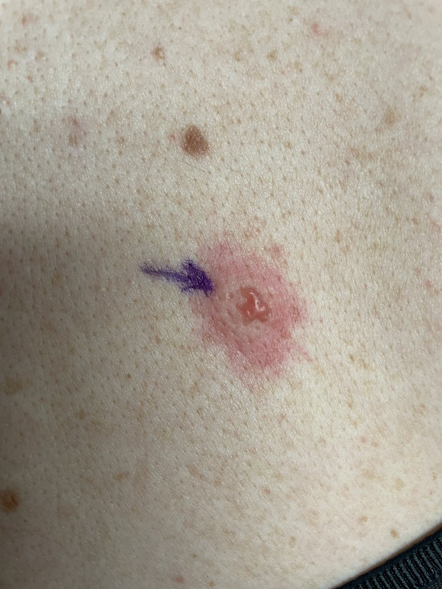becks_bryant's tweet photo. Off to hospital for another #Biopsy on my face tomorrow. Hopefully it won’t result in MORE stitches ! My face is starting to look like the road map of Great Britain! 🤦🏼♀️ #BCC #Contaminates #Firefighter #Decon https://t.co/cCZMTdGFD4