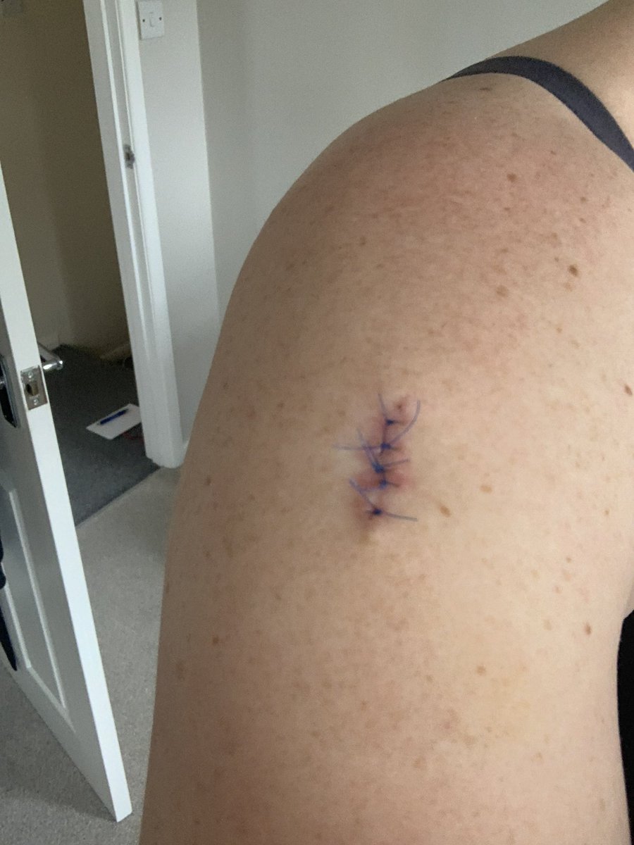 becks_bryant's tweet photo. Off to hospital for another #Biopsy on my face tomorrow. Hopefully it won’t result in MORE stitches ! My face is starting to look like the road map of Great Britain! 🤦🏼♀️ #BCC #Contaminates #Firefighter #Decon https://t.co/cCZMTdGFD4