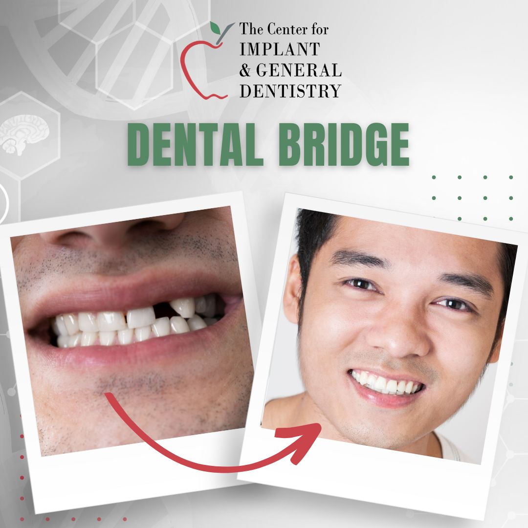 DentistsLindale's tweet photo. Missing a tooth might seem minor, but it can lead to jaw bone deterioration and other dental health issues. Dental bridges offer a permanent solution to this common problem. Contact The Center for Implant and General Dentistry today at 903-730-6651 for more information.

#Den ... https://t.co/kztGqfXaIW