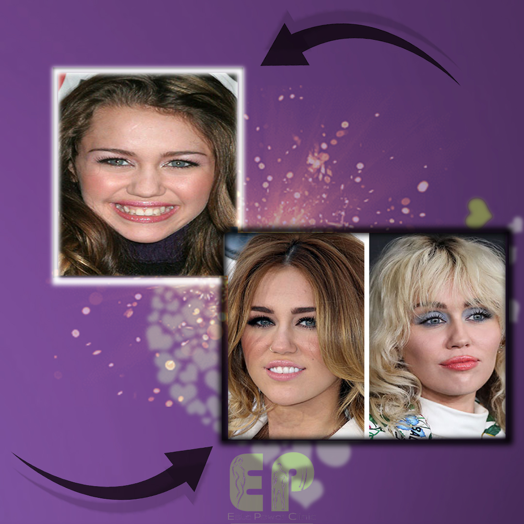 📷📷 Miley Cyrus'un geçirdiği estetik operasyonları inceledik. Geçirdiği tahmin edilen bazı estetik operasyonlar aşağıdaki ekte sizlerle paylaşıyoruz.

estepowerclinic.com

TR📷 0533 596 11 23 - 0534 630 94 05
En📷 📷 +905393016251
Fr📷 +905301357257

#estepowe