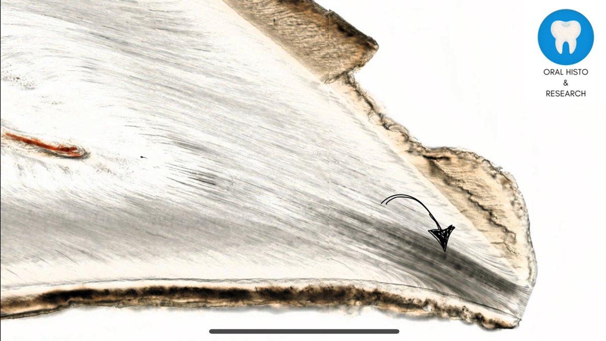 oralhistores's tweet photo. Dead tracts of dentin!
Full video: https://t.co/OyWxWFxSwD
#dentistry #dental #histology #dentin #sensitivity #dentalcare #dentalhealth #patients #PatientCare #research #researchers #Science #YouTube #Video #education #Videos #tooth #cleaning #teeth #OralHealth #TEETH #oral https://t.co/odCT9i7KsN