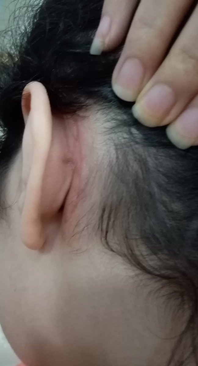 Yeji Oni, I had my ear operated, I can't listen to music for a week, I'm very sad
<a href="/itzybbl/">itzy ㅂㅂㄹ</a>