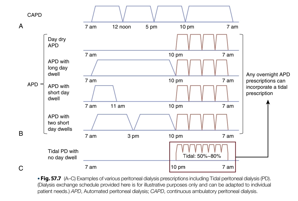 NefroClassMx's tweet image. Peritoneal dialysis 👇

@AvelRomanNeph

#PDfirst #Nephrologist #nefrologia #dialisisperitoneal #peritonealdialysis
