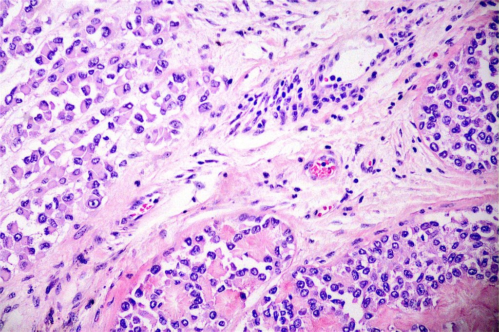 GeronimoJrLapac's tweet photo. Male, 60yo, superficial skin tumor. 7 mitosis/10HPF. Dx and markers?

#dermpath https://t.co/RkudP4izKS