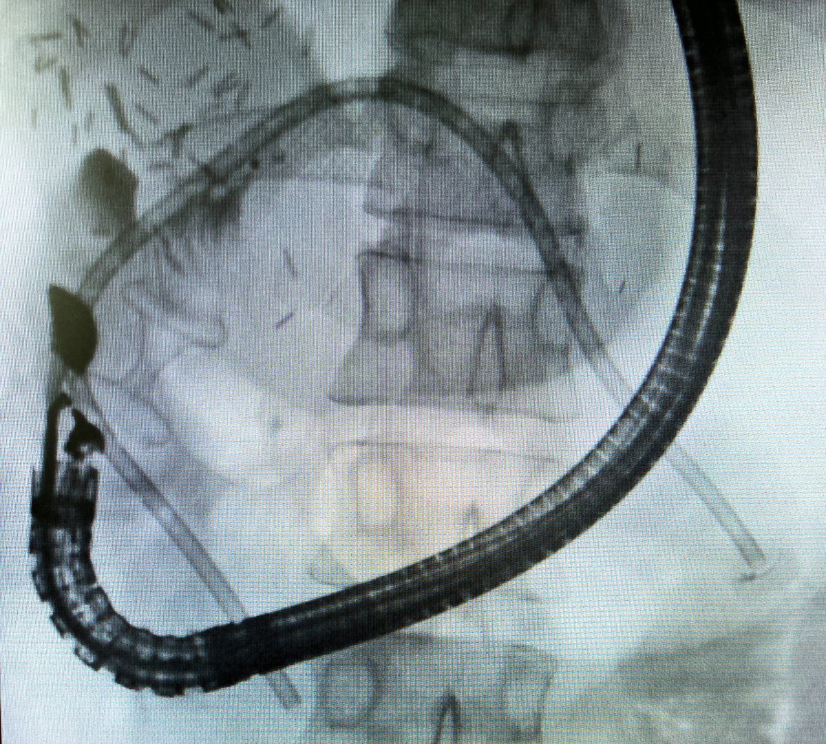 Michael Praktiknjo (@mpraktiknjo) on Twitter photo 🔥First EUS-directed enteroenterostomy (#EDEE) <a href="/UK_Muenster/">Uniklinik Münster</a> to facilitate ERC in a patient with split liver transplant and hepaticojejunostomy stricture (not reachable via enteroscopy).
Thank you <a href="/wim_laleman/">Wim Laleman</a>, endo nurses and anesthesiology 🎉🙏
#endohepatology 🔥First EUS-directed enteroenterostomy (#EDEE) <a href="/UK_Muenster/">Uniklinik Münster</a> to facilitate ERC in a patient with split liver transplant and hepaticojejunostomy stricture (not reachable via enteroscopy).
Thank you <a href="/wim_laleman/">Wim Laleman</a>, endo nurses and anesthesiology 🎉🙏
#endohepatology