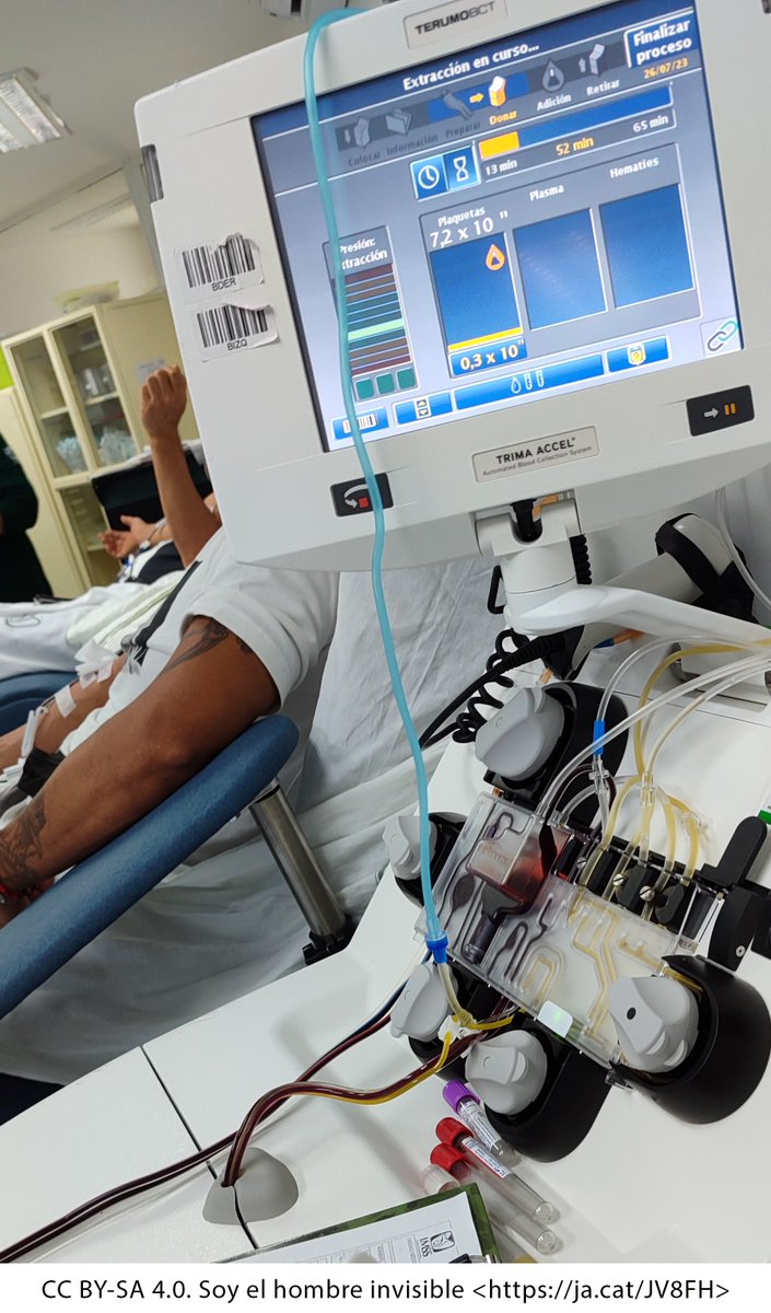 UBDivulga's tweet photo. Afèresi #voldir tècnica de donació de sang en la qual el donant està connectat a una màquina que separa el plasma o plaquetes, retornant a l'organisme la resta de components. Així, el producte que s’obté equival a una dosi terapèutica. https://t.co/y8uP6V0qch #diadeldonantdesang https://t.co/3SFklGbdXR