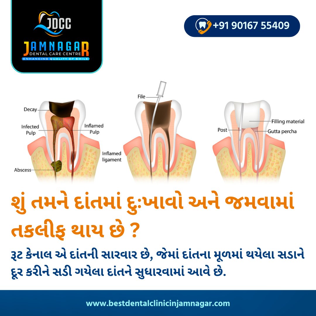 શું તમને દાંતમાં દુઃખાવો અને જમવામાં તકલીફ થાય છે ?
તો આજેજ જામનગર ડેન્ટલ કેર સેન્ટર ની મુલાકાત લો. <a href="/jdccjamnagar/">Jamnagar dental care center</a>

📞 +91 90167 55409
📍 જય માતાજી હોટેલની સામે, જોલી બંગલા પાસે, એસ ટી રોડ, જામનગર - ૩૬૧૦૦૫

#bestdentistinjamnagar #jamnagardentalcarecenter #jdcc #jdccjamnagar