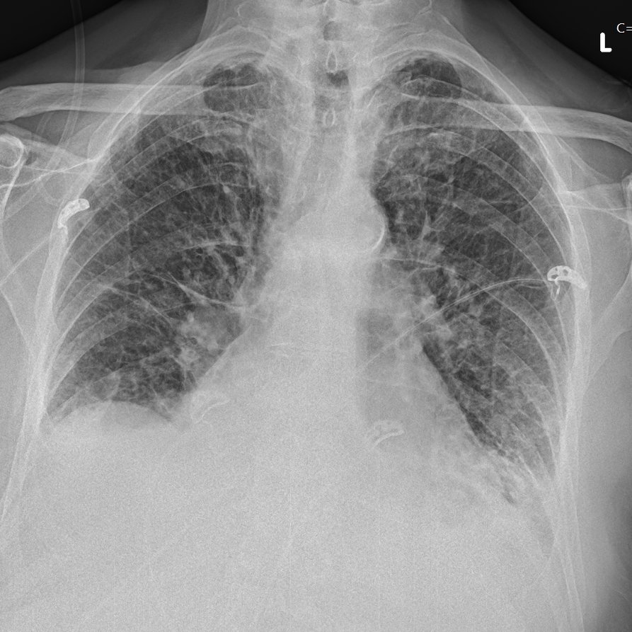 79 year old gentleman presents with a few days' history of shortness of breath on exertion. T1RF on ABG. Team felt x-ray showed some haziness at the left base - treated with IV antibiotics and fluids. Debate about whether to get a CTPA in view of significant O2 requirement. (2/5)
