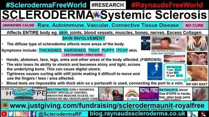 cosmicfairy444's tweet photo. Happy #SclerodermaAwarenessMonth 🌻The Skin Infographic
https://t.co/GanKLlGcmJ
#SclerodermaFreeWorld #RaynaudsFreeWorld
#Research #Scleroderma #SystemicSclerosis #Raynauds #Autoimmune #RareDisease #NoCure #UnknownCause #LifeChanging #ConnectiveTissue #DreamSnatcher #Disability https://t.co/aD9Wq2D9ZX