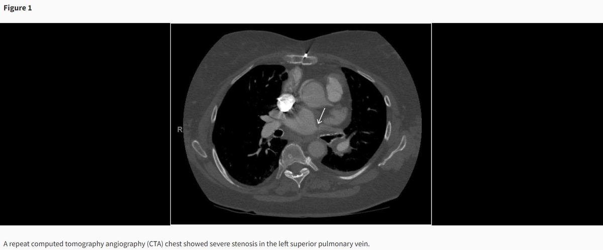 European Society of Cardiology Journals (@esc_journals) on Twitter photo Beware of an uncommon complication after a common #EPeeps procedure - a case of pulmonary vein stenosis bit.ly/3KupF0z
#EHJCaseReports <a href="/aayshacader/">Aaysha Cader</a> <a href="/ANazmiCalik/">A.Nazmi Calik</a> <a href="/TJ_Yeo/">Tee Joo YEO</a> <a href="/Phiso_de/">Philipp Sommer</a> <a href="/EHJCREiC/">EHJCaseReports Editor-in-Chief</a> #CardioX #radialfirst #yesCCT Beware of an uncommon complication after a common #EPeeps procedure - a case of pulmonary vein stenosis bit.ly/3KupF0z
#EHJCaseReports <a href="/aayshacader/">Aaysha Cader</a> <a href="/ANazmiCalik/">A.Nazmi Calik</a> <a href="/TJ_Yeo/">Tee Joo YEO</a> <a href="/Phiso_de/">Philipp Sommer</a> <a href="/EHJCREiC/">EHJCaseReports Editor-in-Chief</a> #CardioX #radialfirst #yesCCT