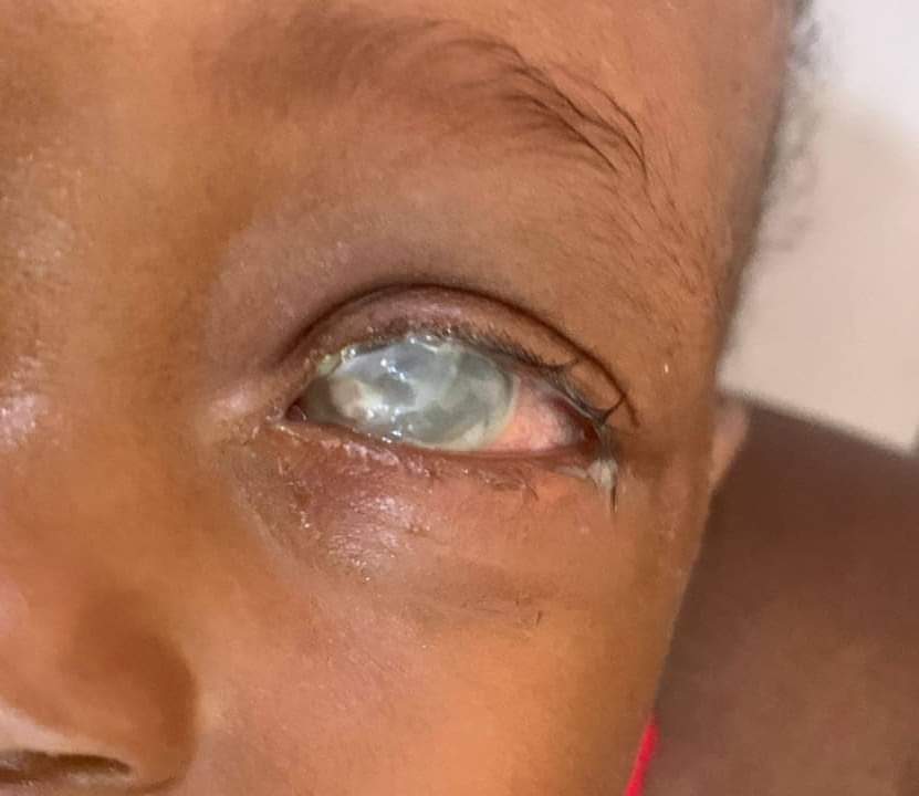 Valadoms's tweet photo. Breast milk was what her parents used. Any attempt to save her sight would cost 10m. This is what just 50k would have resolved. 

Breast milk is not an eye-drop
Breast milk is not an eye-drop
Breast milk is not an eye-drop
Breast milk is not an eye-drop https://t.co/cwv6G5rapx