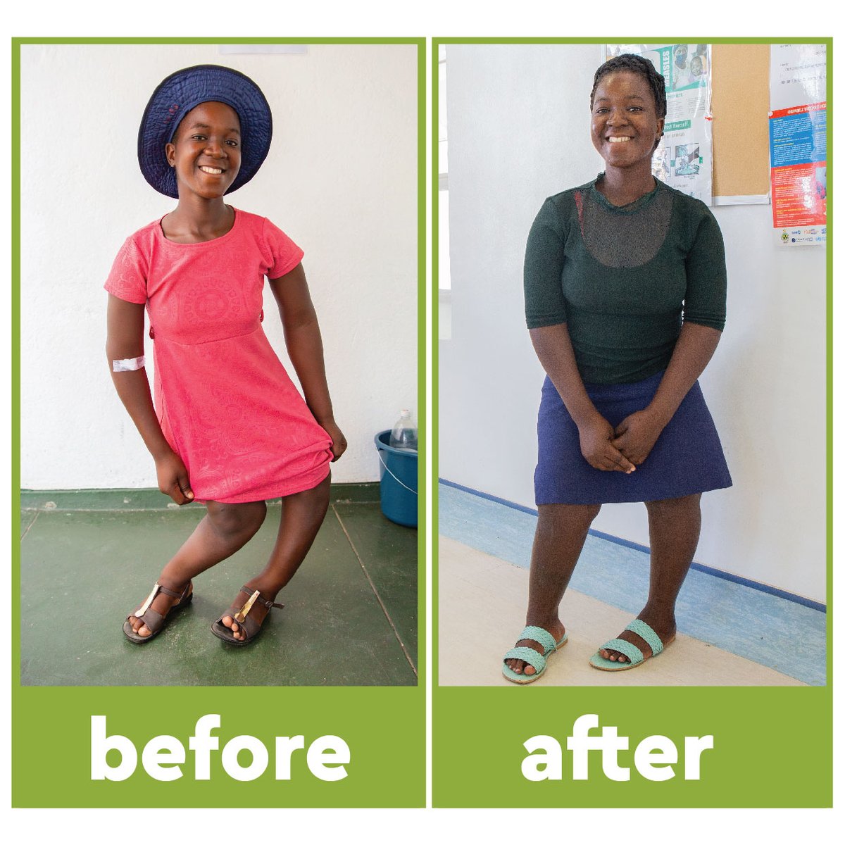 curezimbabwe's tweet photo. Pride's smile keeps getting bigger and brighter! Since arriving @curezimbabwe for treatment of #windswept knees, her confidence has blossomed alongside her ability to walk. Now, she walks with purpose, no longer limited by her condition.
It's stories like hers that inspire us! https://t.co/GOHrECluQW