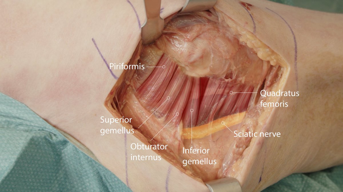 ASchlenzka's tweet photo. Posterior approach to the hip for total hip arthroplasty - key anatomical structures highlighted.
#THA #PosteriorApproach #SciaticNerve #Anatomy #OrthoX #Orthotwitter https://t.co/LpWPL1UYZ5