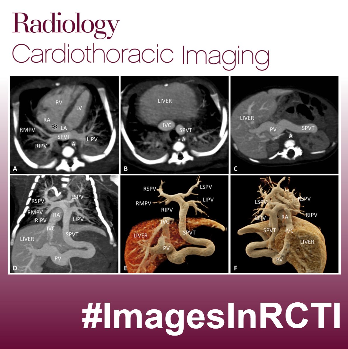 Francisco Calle (@fcallemd) on Twitter photo Excited to launch #ImagesInRCTI and #InTrainingRCTI posts, highlighting Images in Publications from <a href="/RadiologyCTI/">Radiology: Cardiothoracic Imaging</a> ! 🫀🫁🚀
1/2)
An 11-day-old male neonate presented with cyanosis and dyspnea
What is the diagnosis?
What are the findings? Excited to launch #ImagesInRCTI and #InTrainingRCTI posts, highlighting Images in Publications from <a href="/RadiologyCTI/">Radiology: Cardiothoracic Imaging</a> ! 🫀🫁🚀
1/2)
An 11-day-old male neonate presented with cyanosis and dyspnea
What is the diagnosis?
What are the findings?