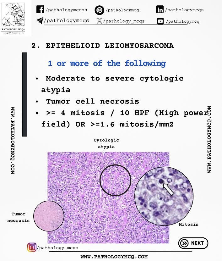 Pathology_mcqs's tweet photo. Diagnostic criteria of Leiomyosarcoma - According to WHO 2022 

#pathtwitter #pathologymcqs #fgt #leiomyoma #leiomyosarcoma #pathtwitter #fgtpath https://t.co/8s0N6Zly9w