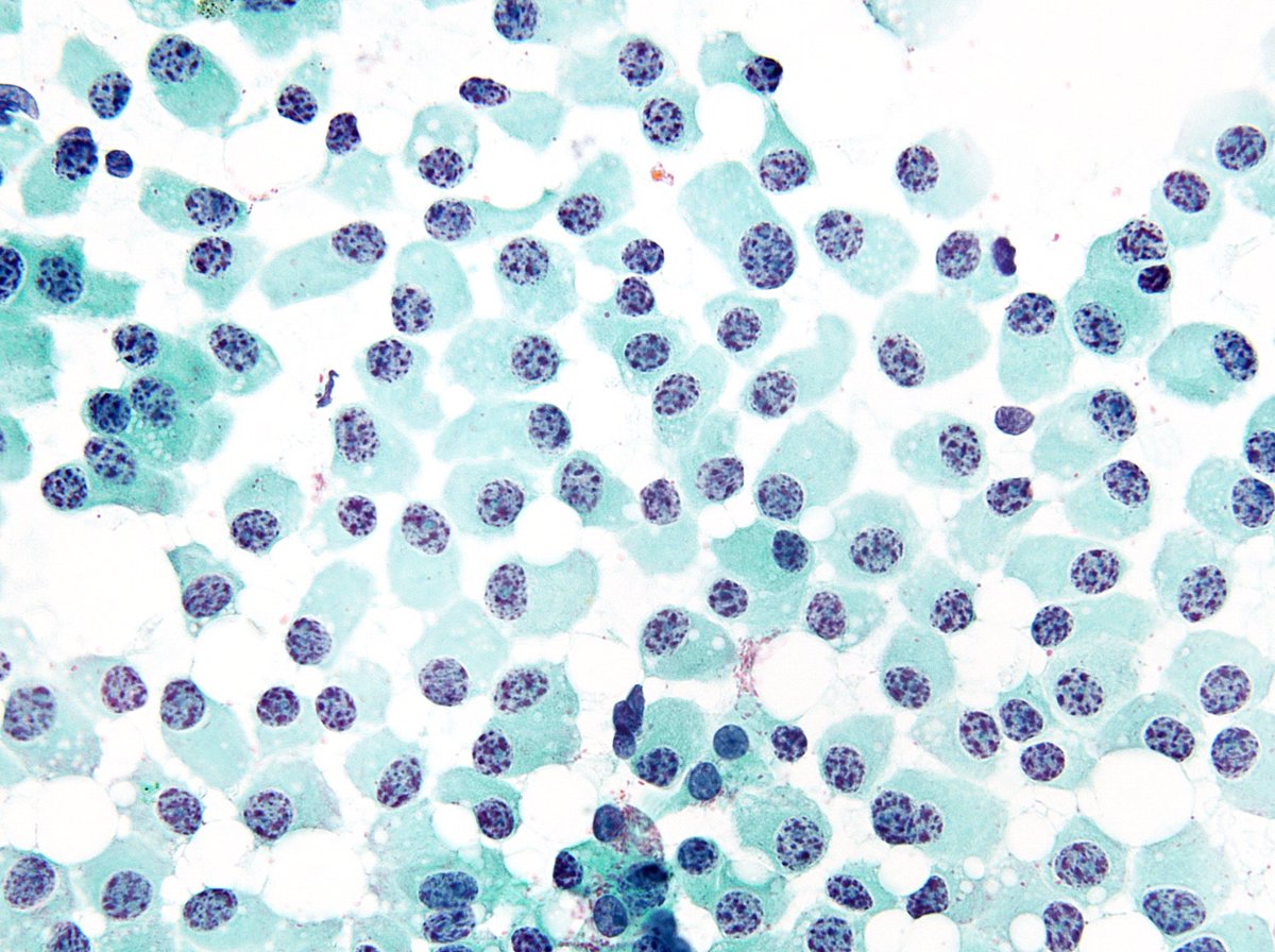“It can’t get any better” - Pancreatic Neuroendocrine Tumor” (PanNET), a slam dunk diagnosis. (FNA)