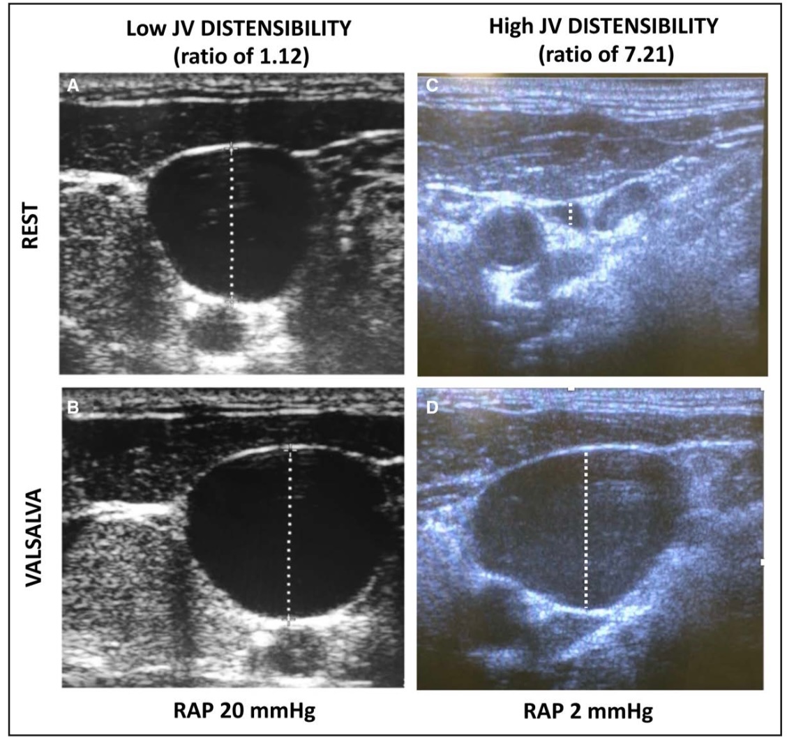 Estimation of Right Atrial Pressure by Internal Jugular Vein Distensibility #POCUS in Patients With #HeartFailure
A JV distensibility ratio >1.6 had PPV of 0.86 to identify patients with RAP ≤7 mm Hg
#MedEd #Nephpearls 
🔗 pubmed.ncbi.nlm.nih.gov/38299348/