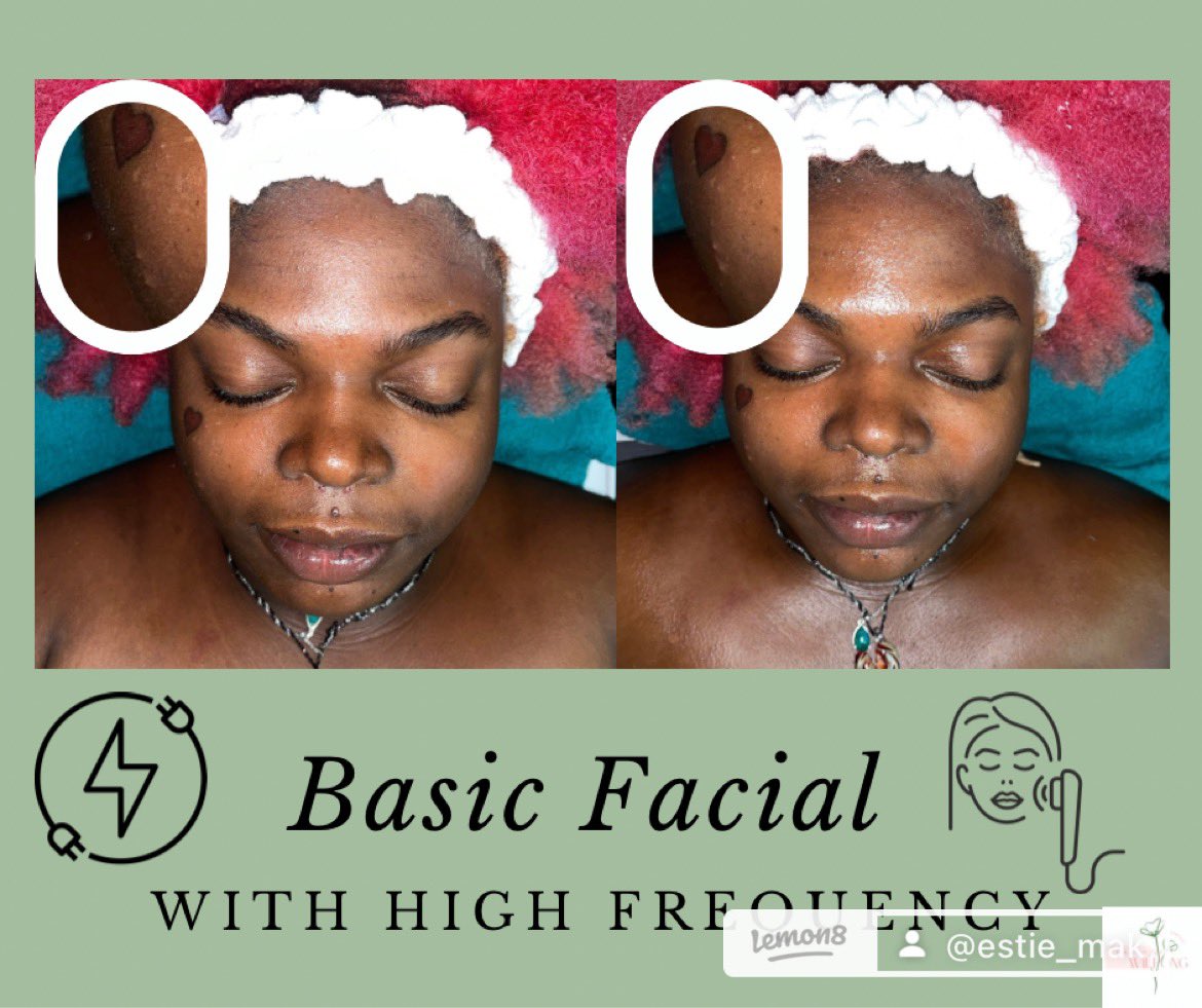Makshroomm's tweet photo. Was able to use the high frequency machine! This was so cool to see how it pulled her acne more to the surface!
#dermalogica #estheticanstudent #esthetian #highfrequency #acne #protips https://t.co/McchjYRFm4