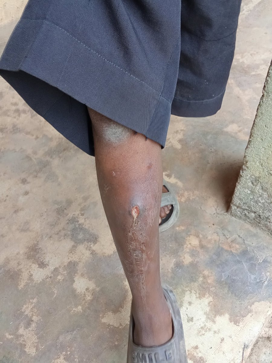 Orey_ray's tweet photo. Never done this before but here goes....

There is a student in my class, he fell from a tree while he was playing with his elder brother 5 years ago (when he was 6, now 11) and dislocated his knee and also sustained injury in his arm. https://t.co/v8RK3y0Rts