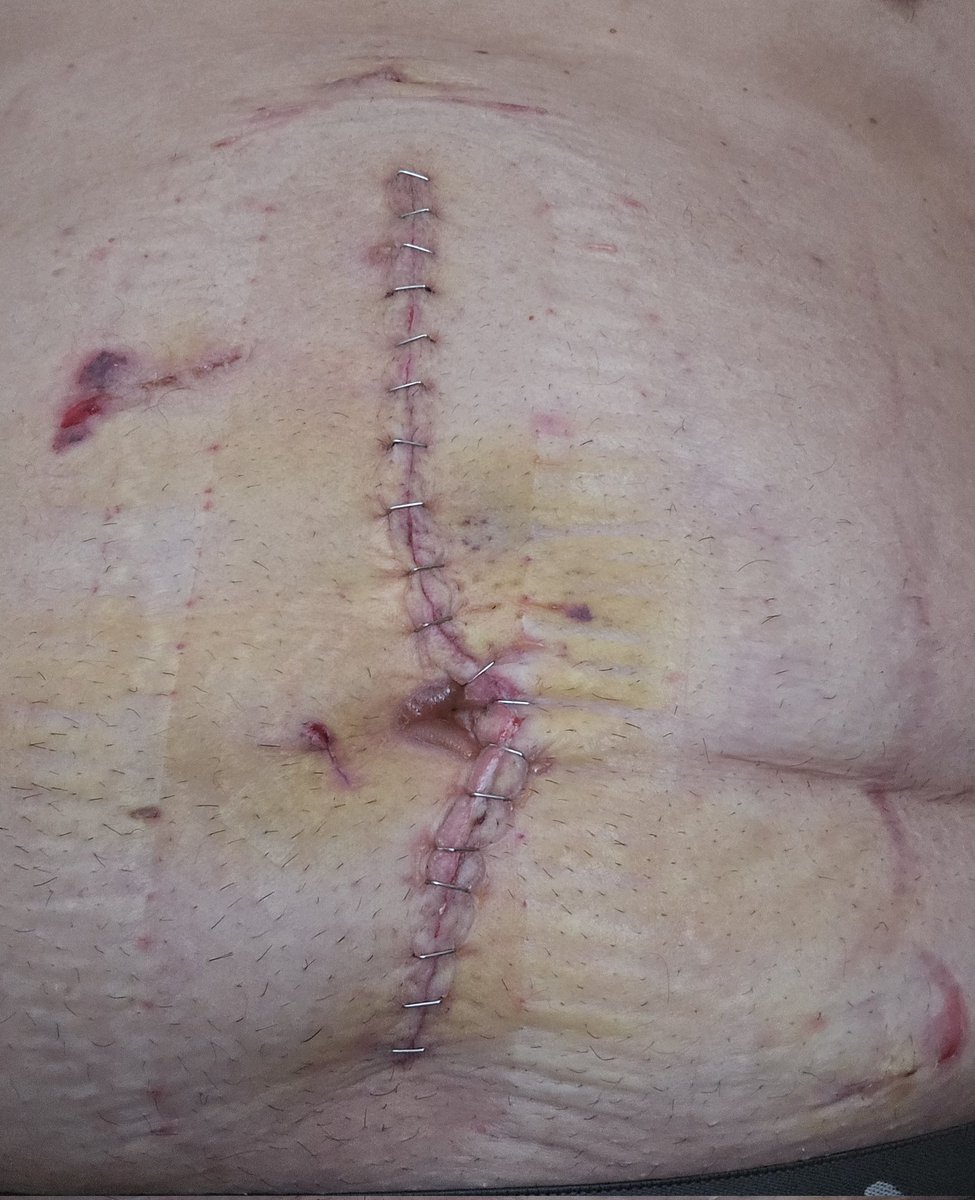 ODgreenTrader's tweet photo. Hey $mmat $mmtlp fam!! Sorry I've been absent for a while, but I've had some medical stuff I needed to take care of. Its gonna be a long road of healing, but with God in control, everything will be ok. I haven't forgotten you in my prayers but I could use some for myself. https://t.co/QTJ3QChdBC