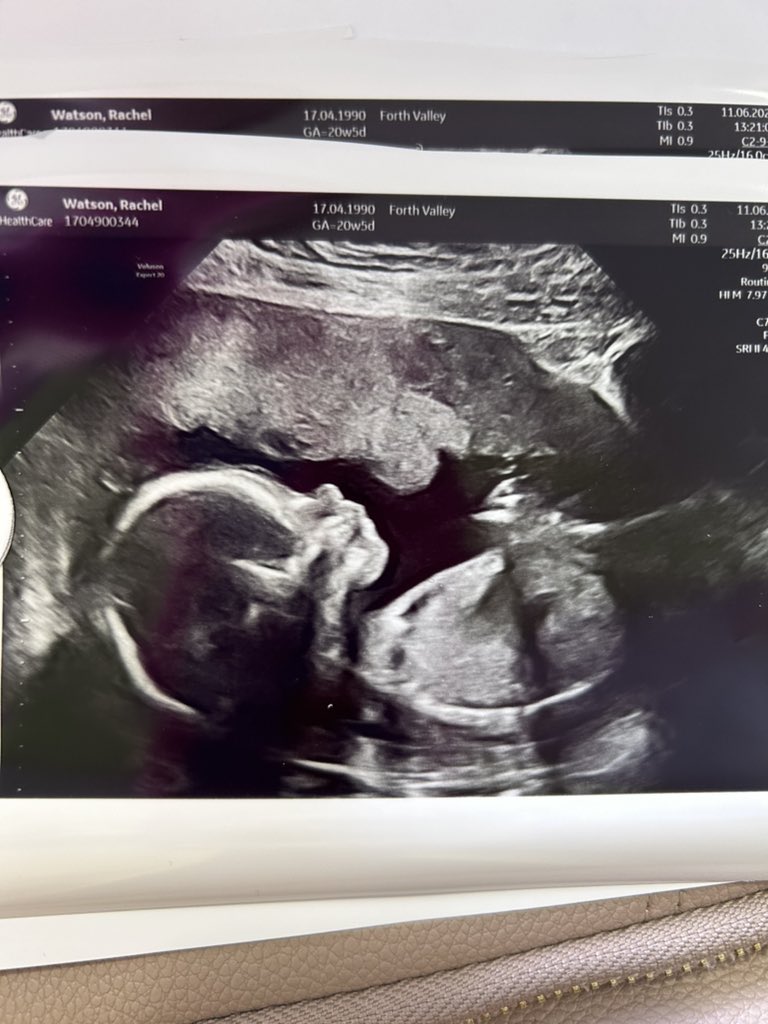 rachel_76's tweet photo. Relieved that our baby girl is healthy at her 20 week check, now for Nando’s, new pjs and my bed, these hormones are no joke 😭 https://t.co/BSeVMZapc1