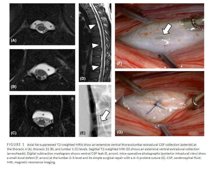 Headache Journal (@headachejournal) on Twitter photo This brief communication report describes 2 cases of adolescents with post-dural puncture #headache & #paraplegia
…adachejournal.onlinelibrary.wiley.com/doi/full/10.11…
<a href="/WouterSchievink/">WouterSchievink</a> <a href="/marcelmaya/">Marcel Maya</a> et al This brief communication report describes 2 cases of adolescents with post-dural puncture #headache & #paraplegia
…adachejournal.onlinelibrary.wiley.com/doi/full/10.11…
<a href="/WouterSchievink/">WouterSchievink</a> <a href="/marcelmaya/">Marcel Maya</a> et al