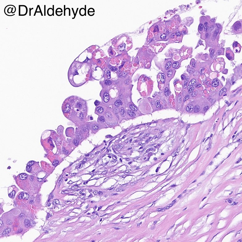 🌟 Exciting Opportunity Alert! 🌟 Join MD Anderson's prestigious Surgical Pathology fellowship for 2025-2026! Learn from the nation's top experts in a renowned program. If interested, contact <a href="/DrPhyuPAung2/">Dr Phyu P Aung</a> today! Don't miss out on this career-defining experience. #MDACCPath 😆🔬