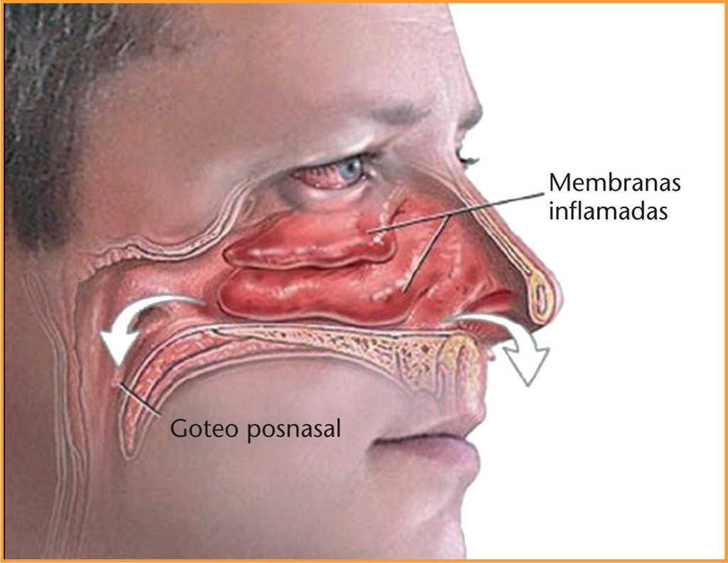 Para tratar la rinorrea posnasal:

Si siente que tiene mucha mucosidad o flema acumulándose en la garganta, es posible que tenga goteo posnasal.

Esto sucede cuando las glándulas de la nariz producen moco y corren por la parte posterior de la nariz hasta la garganta.

Esto es