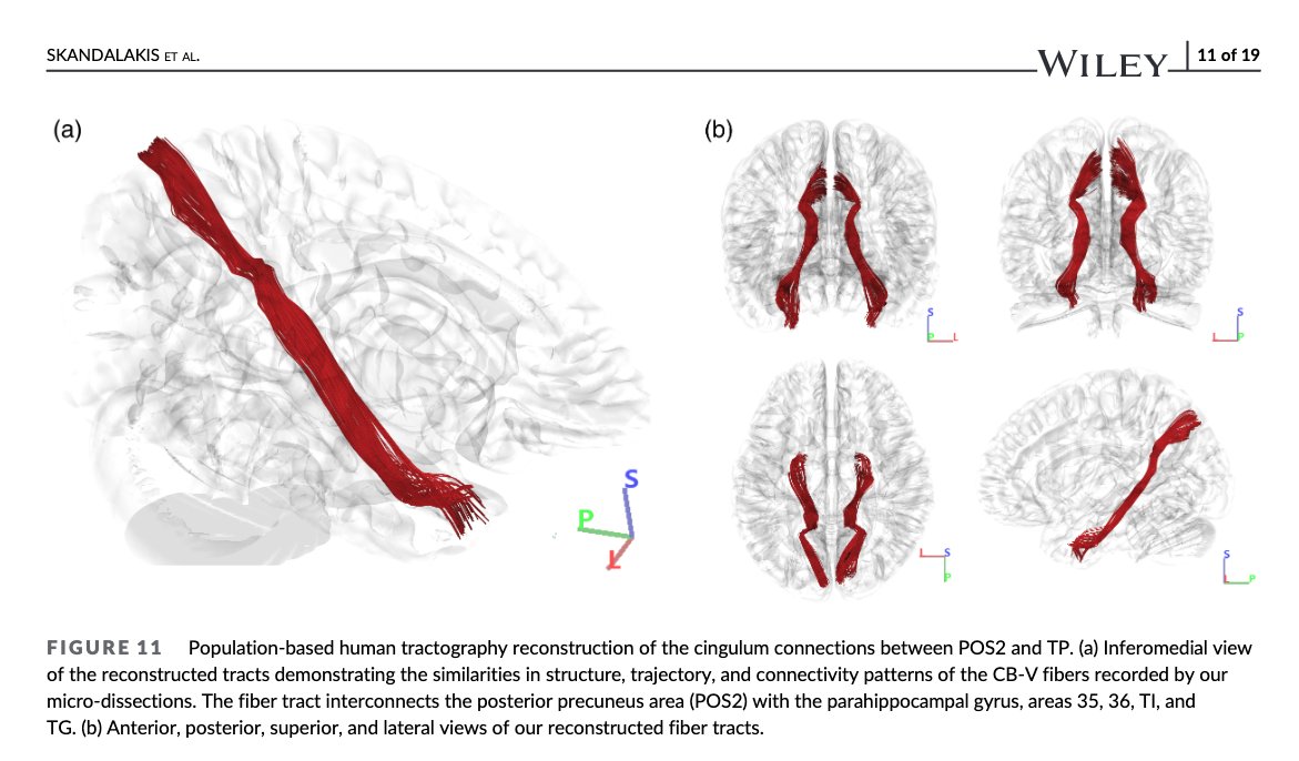 Syed Faraz Kazim, MD, PhD (@kazimsyed_neuro) on Twitter photo Recent paper by my friend <a href="/GSkandalakis/">Georgios Skandalakis</a> revealing a direct axonal connection between precuneus and temporal pole employing fiber microdissections and tractography in human and rhesus macaque brains. <a href="/UNMNeurosurgery/">UNM Neurosurgery</a> <a href="/PittNeurosurg/">Pitt Neurosurgery</a> <a href="/UofTNeuroSurge/">University of Toronto Neurosurgery</a> <a href="/MichaelKogan20/">Michael Kogan</a> Recent paper by my friend <a href="/GSkandalakis/">Georgios Skandalakis</a> revealing a direct axonal connection between precuneus and temporal pole employing fiber microdissections and tractography in human and rhesus macaque brains. <a href="/UNMNeurosurgery/">UNM Neurosurgery</a> <a href="/PittNeurosurg/">Pitt Neurosurgery</a> <a href="/UofTNeuroSurge/">University of Toronto Neurosurgery</a> <a href="/MichaelKogan20/">Michael Kogan</a>