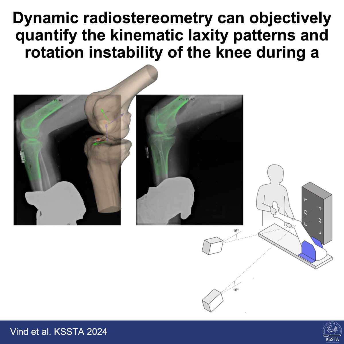 KSSTA's tweet image. Dynamic RSA might be a novel tool to reliably quantify the pivot shift test, according to this novel study.
 
#knee #biomechanics #pivotshift #diagnostics
 
Read here: doi.org/10.1002/ksa.12…