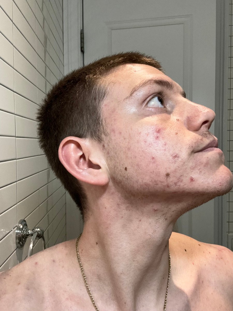 AcneHub's tweet image. June 23, 2024:
3 boiled eggs
Celery, nutzo butter 
Wings
Wash: WW, TT