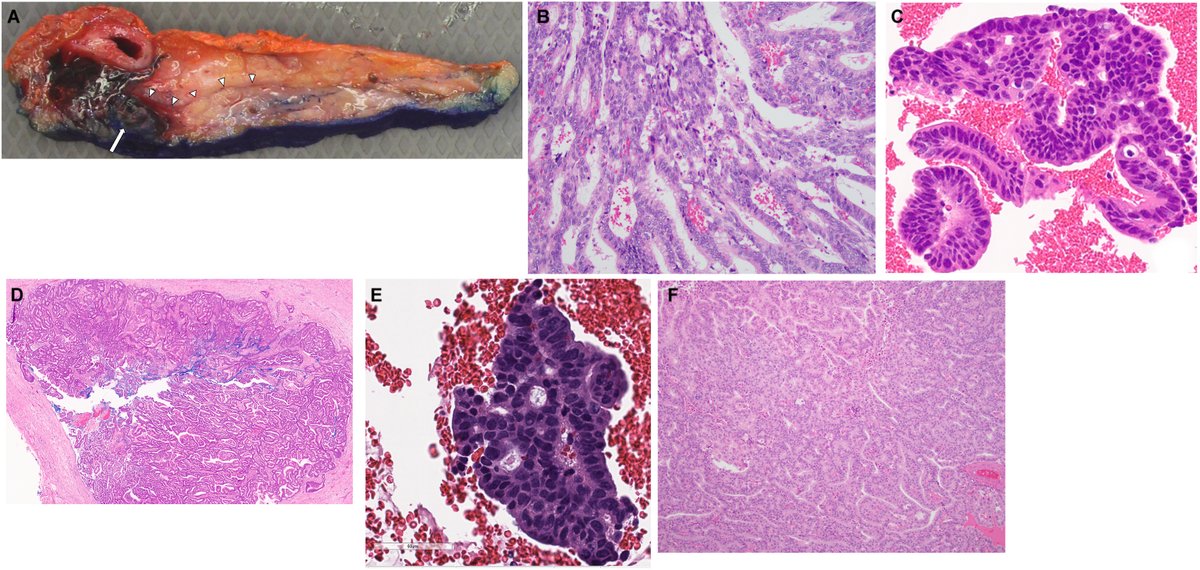 Human_Pathology's tweet photo. New in #HumPathol: Molecular and Morphologic Characterization of Intraductal Tubulopapillary Neoplasms of Pancreas with Novel Potentially Targetable Fusions. https://t.co/VwwQn00n9Y #pathology #PathTwitter #PathX #GIpath #pancpath https://t.co/lN78EChupL