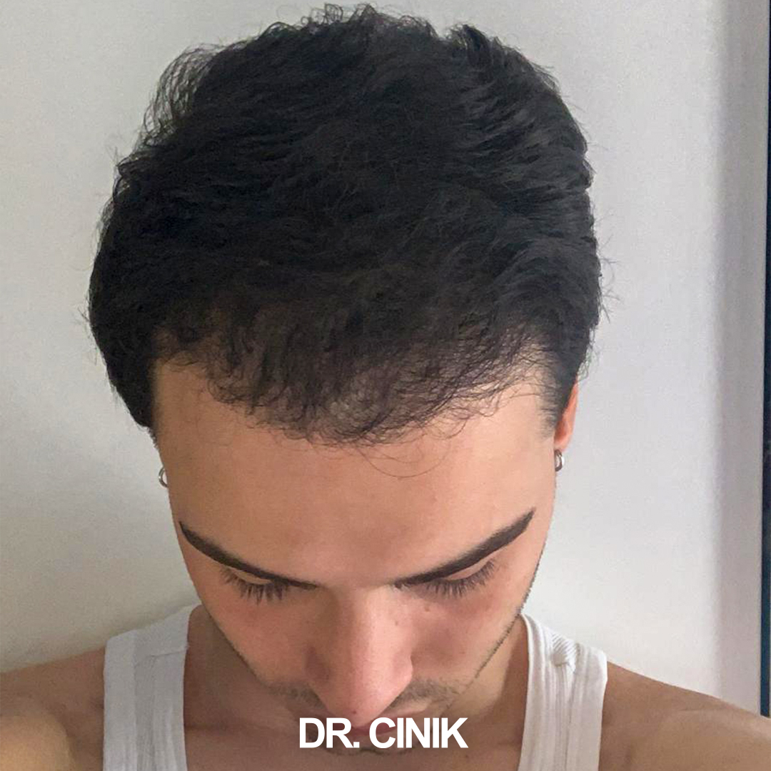 drcinikofficial's tweet image. 🌟 Amazing transformation alert! After 12 months and 4000 #grafts using the #DHI method, look at these incredible results from #DrCinik. We're transforming lives, one hair at a time💪

📞 +90 549 641 37 01 | 🌐 drcinik.com

#HairTransplant  #DHI #TransformationTuesday